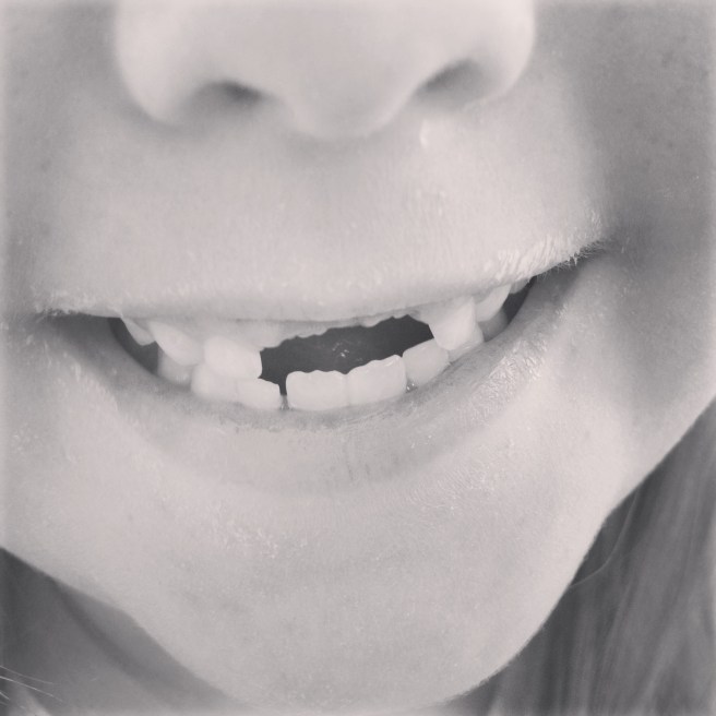 the front teeth came out after weeks of wobbling